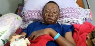 Frans Tabuni, siswa SMP N 1 Wamena yang mengalami luka bakar setelah menolak ajakan simpatisan KNPB untuk demo
